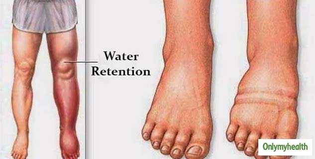 symptoms of fluid retention