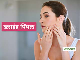 Blind Pimple: काफी दर्दनाक हो सकते हैं ब्‍लाइंड पिंपल, जानें क्‍या हैं इसके कारण और इससे निपटने के उपाय 