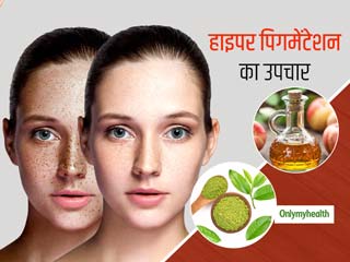 चेहरे से निखार छीन लेता है हाइपर पिगमेंटेशन, इन 5 नेचुरल चीजों से करें इसका उपचार