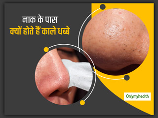 नाक पर आए काले धब्बों को भूलकर भी न करें नजरअंदाज, हो सकता है ट्राइकोस्टेसिस स्पिनुलोसा डिसऑर्डर का संकेत