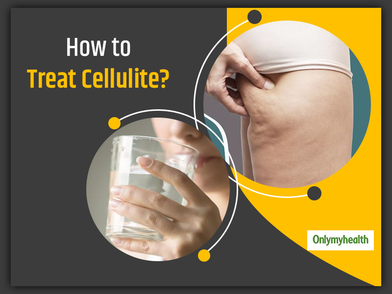 How To Get Rid Of Cellulite On Thighs?