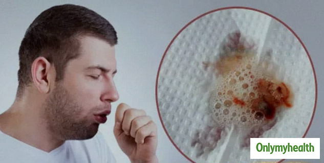 Bloody Cough Or Haemoptysis
