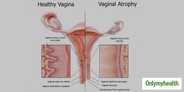 What is Vaginal Atrophy?