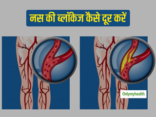 नसों की ब्लॉकेज दूर करने के लिए अपनाएं ये 3 खास उपाय, जल्द मिलेगी दर्द से राहत