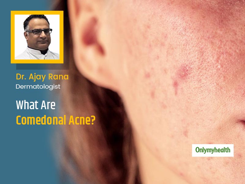Acne Care 101: What Are Comedonal Acne, Their Causes and Tips To Treat Them