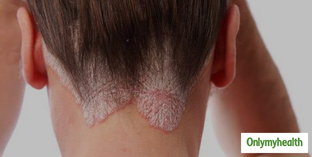 experiencing-scabs-on-scalp-check-out-these-symptoms-causes-and