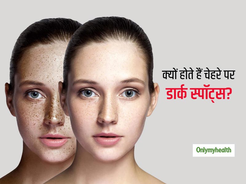 इन 3 कारणों से होती है डार्क स्पॉट्स की समस्या, जानें इससे बचाव के लिए खास स्किन केयर टिप्स