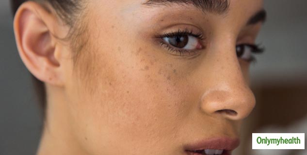 dark spots causes on face