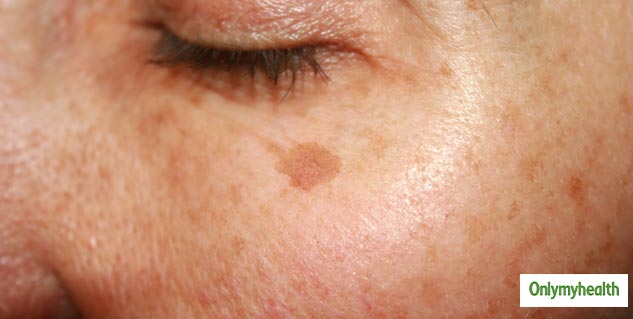 dark spots remove tips