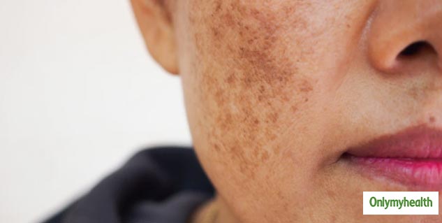 dark spots due to pimples