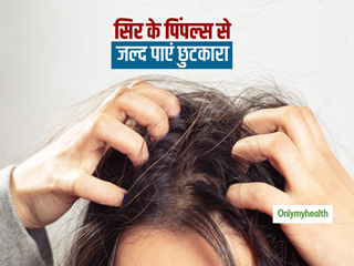 अगर आप भी परेशान हैं सिर में हो रहे दानों से तो जरूर अपनाएं ये टिप्स