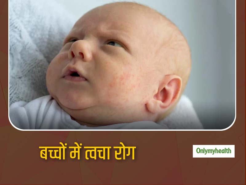 know-the-different-types-of-skin-disorders-in-children-in-hindi