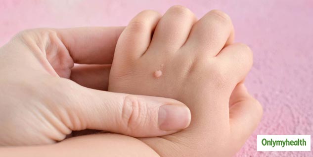 skin tags and warts in kids