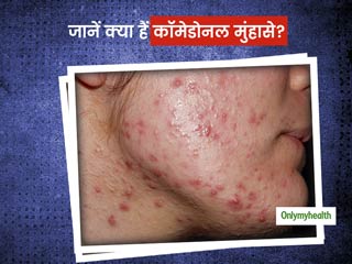 चेहरे पर छोटे-छोटे पस भरे लाल दाने हो सकते हैं कॉमेडोनल मुंहासे, एक्सपर्ट से जानें इन मुंहासों का कारण और इलाज