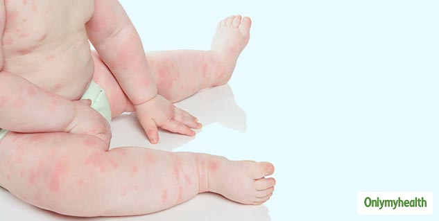 Thrombocytopenia disease in hindi