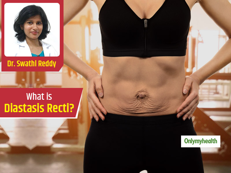 What Is The Mom Pooch? How To Identify & Treat Diastasis Recti