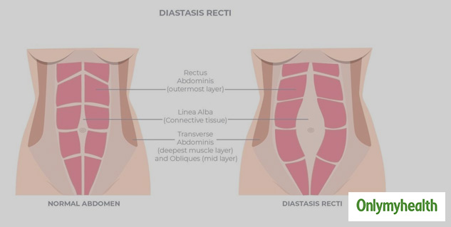 Diastasis Recti: A Medical Condition That Should Not Be Ignored