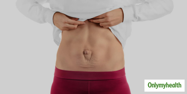 Diastasis Recti: A Medical Condition That Should Not Be Ignored