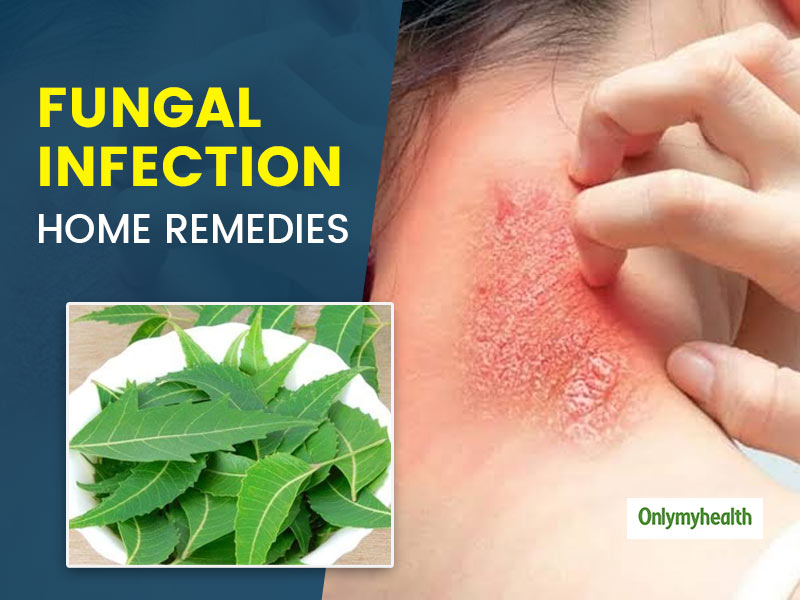 How To Cure Fungal Infection On Face Naturally