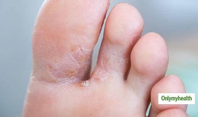 fungal-skin-infection-bothering-you-here-are-5-home-remedies-to-get