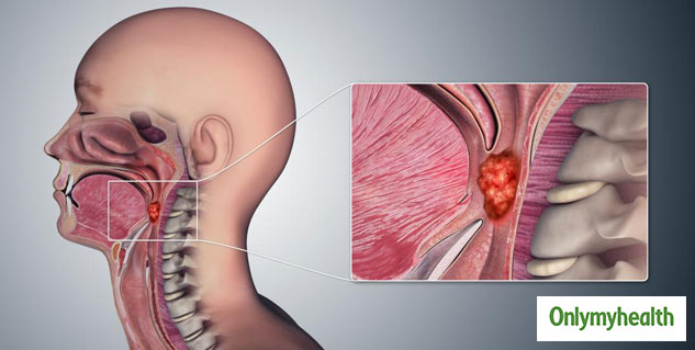 insidethroatcancer