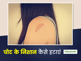 शरीर पर पूरानी चोट के निशान लगते हैं भद्दे तो इन टिप्स को जरूर अपनाएं