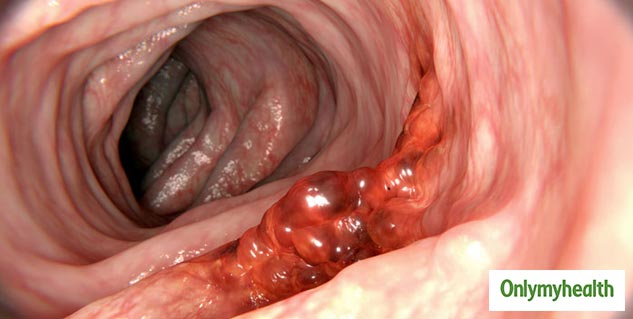 colon cancer in hindi