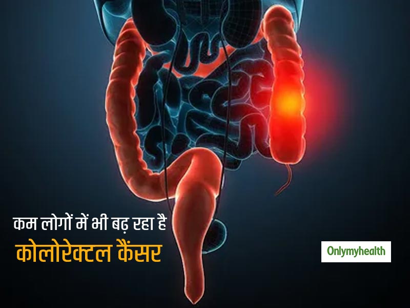 Colorectal Cancer: क्या नौजवानों में कोलोरेक्टल कैंसर (पेट का कैंसर) का अधिक खतरा होता है, जानिए