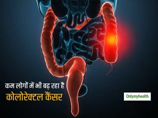 Colorectal Cancer: क्या नौजवानों में कोलोरेक्टल कैंसर (पेट का कैंसर) का अधिक खतरा होता है, जानिए