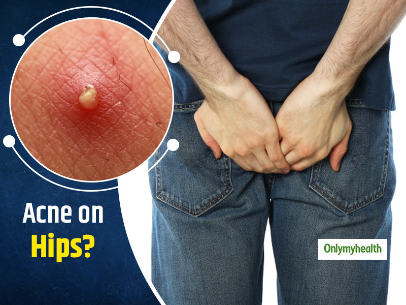 Pimple on Butt: How to Identify and Treat Butt Bumps