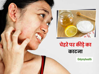 चेहरे पर काट ले कोई कीड़ा तो तुरंत करें ये 4 काम, खुजली और जलन से मिलेगा आराम