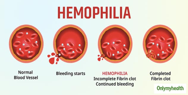 Hemophilia Symptoms: These 3 Conditions Could Be Possible Indicators Of ...