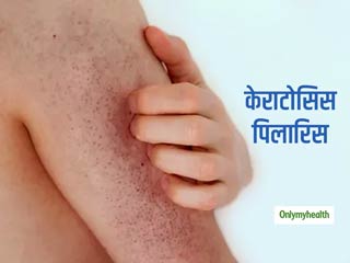 Keratosis Pilaris: डर्मेटोलॉजिस्ट से जानें त्‍वचा में दानें केराटोसिस पिलारिस और के कारण, लक्षण और इलाज 