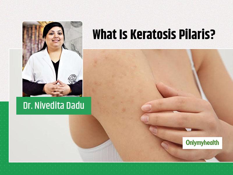 All You Need To Know About Keratosis Pilaris From Renowned Dermatologist Onlymyhealth