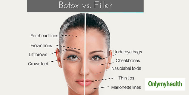 botox-and-filler-difference