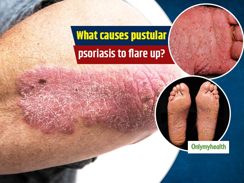how is pustular psoriasis causes