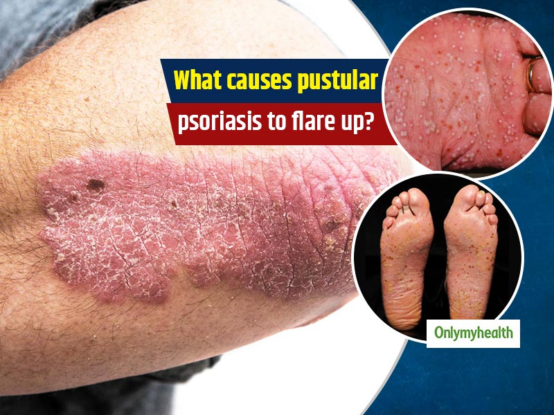 Típus kiütés psoriasis