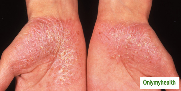Psoriasis