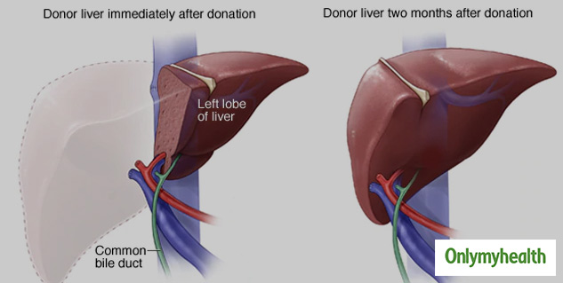 what-happens-in-liver-transplant