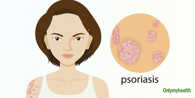 psoriasis