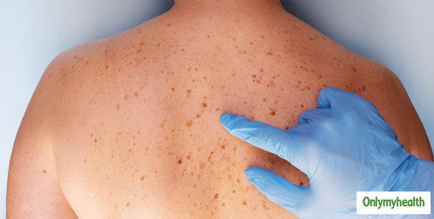 signs of skin cancer