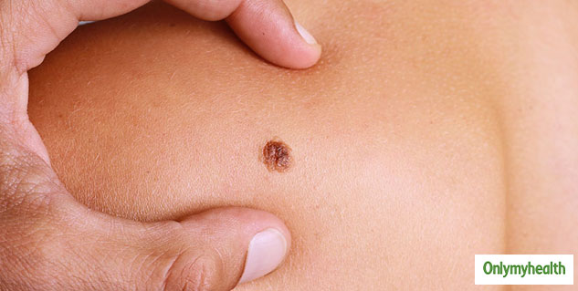 skin cancer