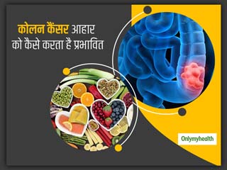 कोलन कैंसर और आपका आहार कैसे एक दूसरे को करते हैं प्रभावित, जानें कैसे रखें खुद को स्वस्थ