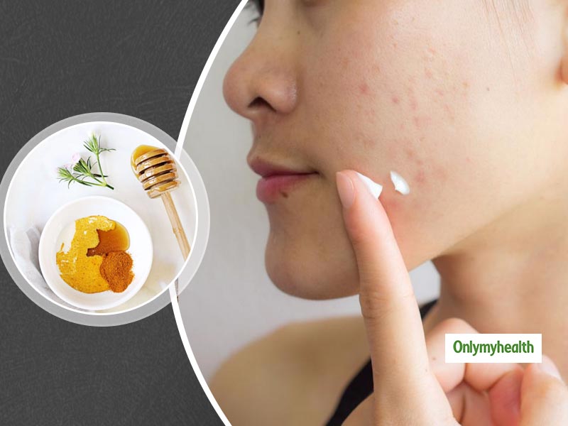 Here Are Four Natural Home Remedies To Banish Those Stubborn Skin Spots