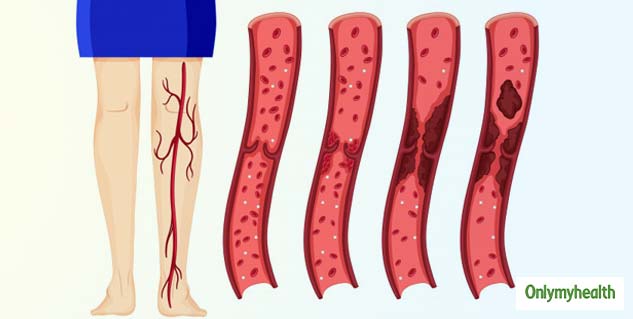 dvt