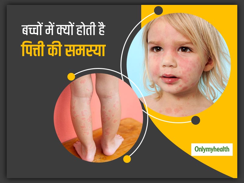 बच्चों में क्यों होती है पित्ती की ज्यादा शिकायत, जानें क्या है इससे बचाव और घरेलू इलाज
