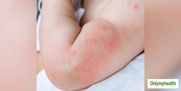 hives