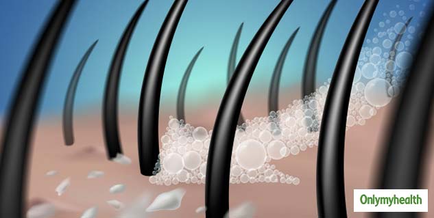 dandruff problem