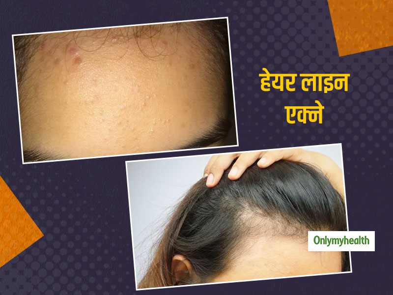 Hairline Acne: जानें क्‍या है हेयरलाइन एक्‍ने के कारण और कैसे पाएं इस समस्‍या से छुटकारा