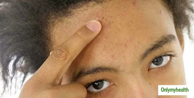 Hairline Acne